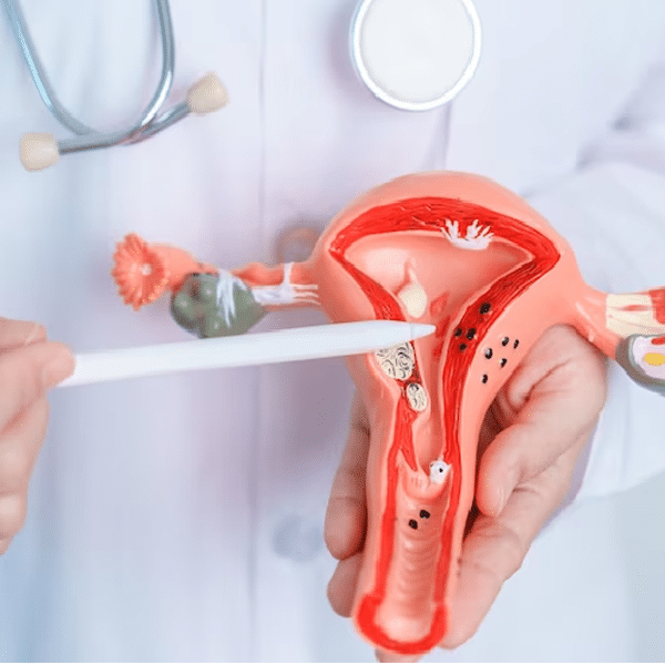 علائم و درمان کیست اندومتریوما