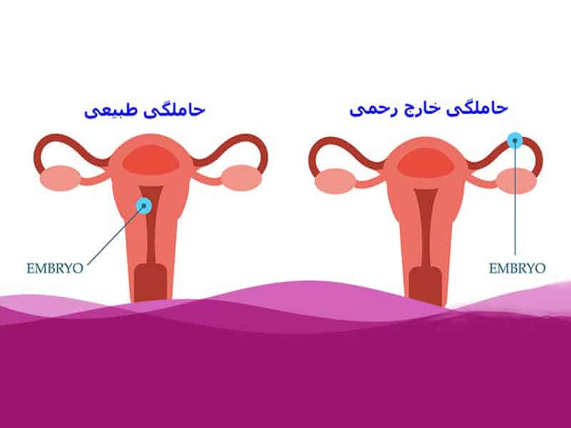بارداری-خارج-از-رحم