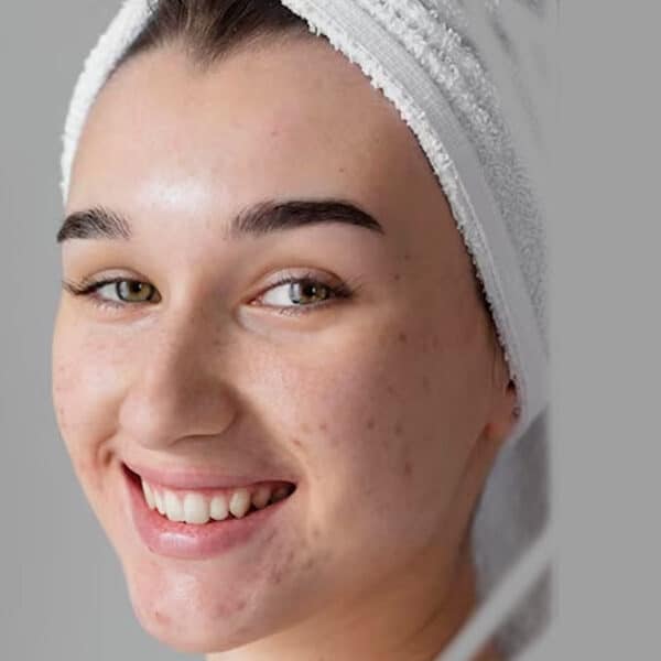 درمان-جوش-های-هورمونی