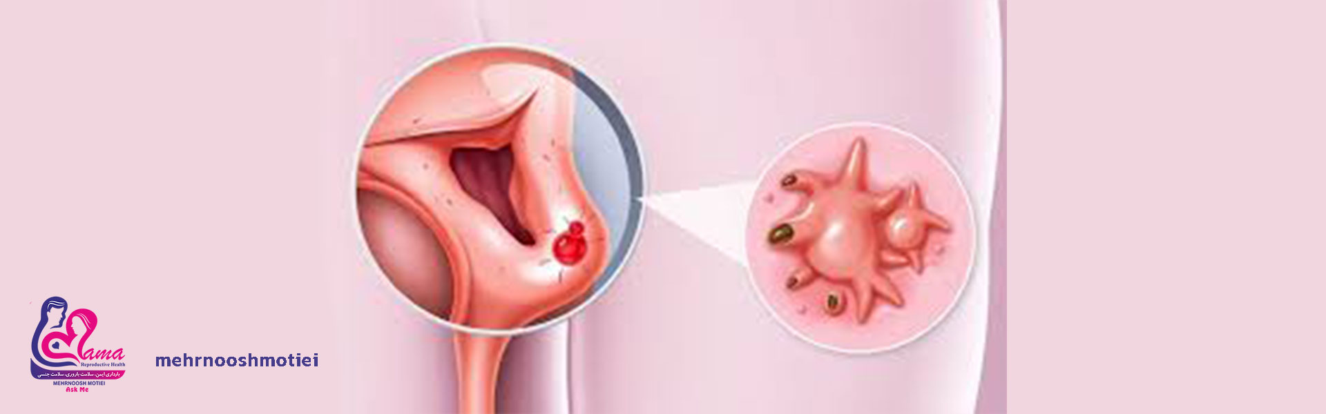 درمان-قطعی-عفونت-واژن