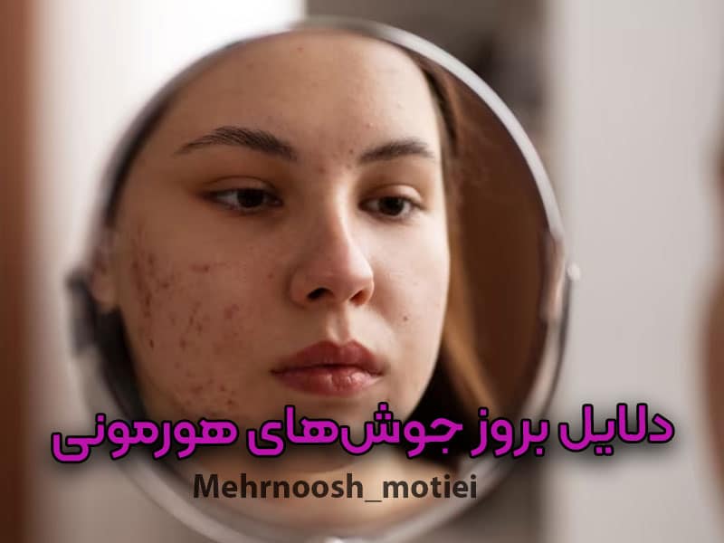 دلایل بروز جوش‌های هورمونی